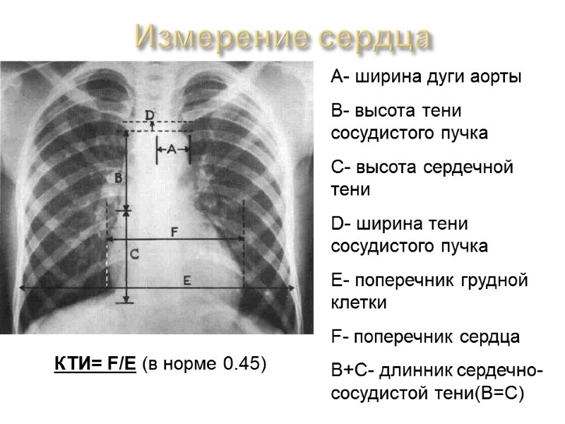 Измерение сердца А- ширина дуги аорты В- высота тени сосудистого пучка С- высота сердечной